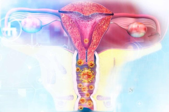 endometrite do útero