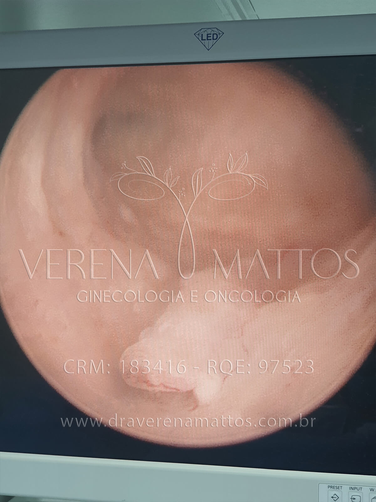 Foto de Histeroscopia: Por Dentro do Útero