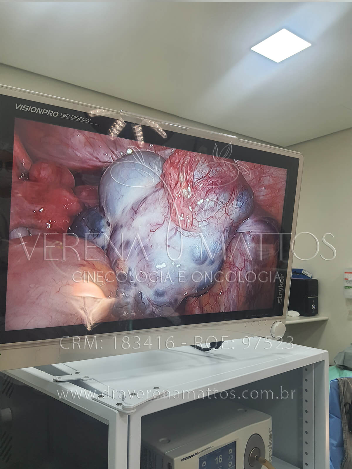 Foto de Câncer de Ovário por Laparoscopia