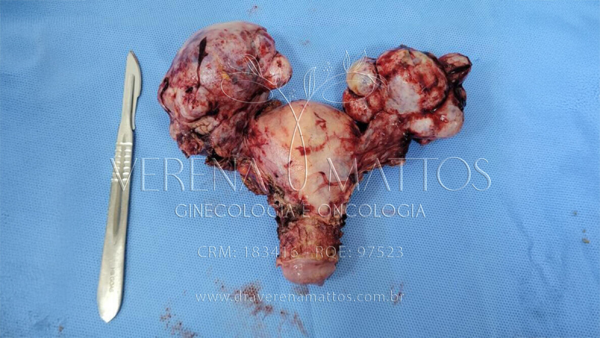Foto de Câncer de Ovário