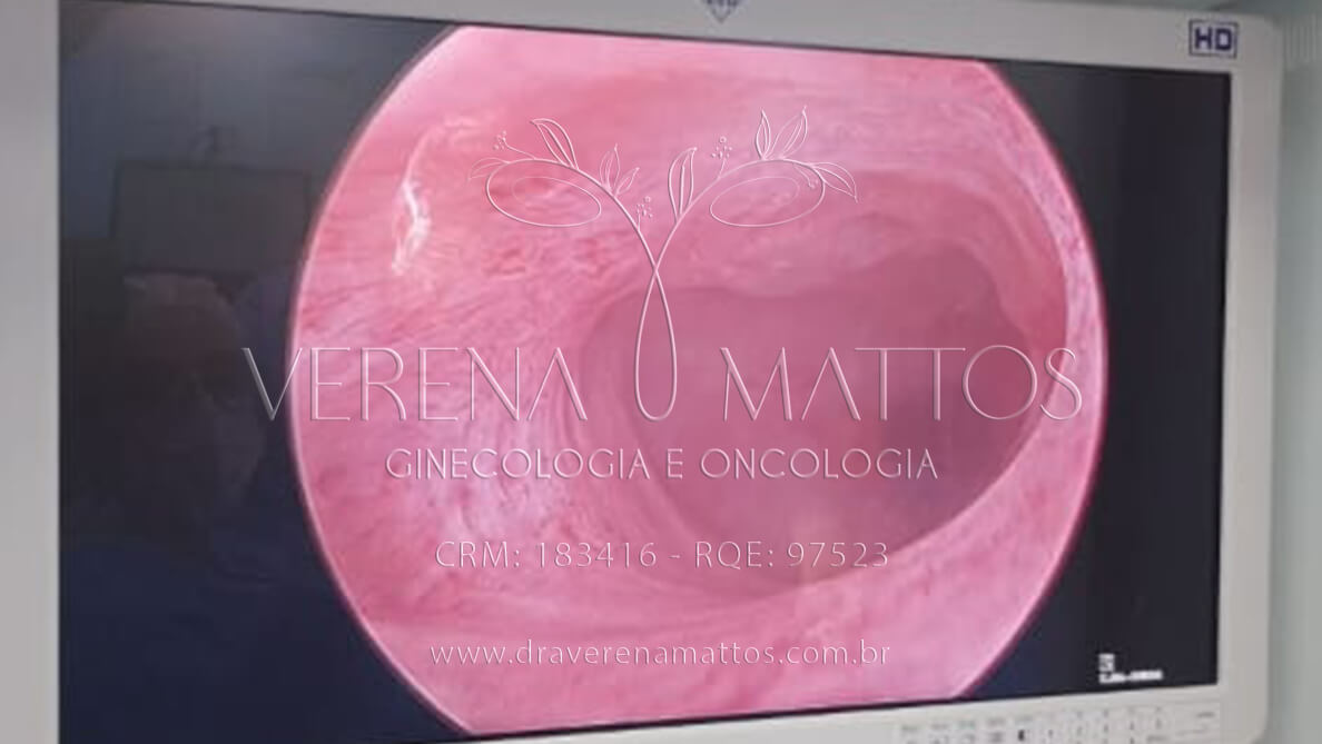 Foto de Histeroscopia