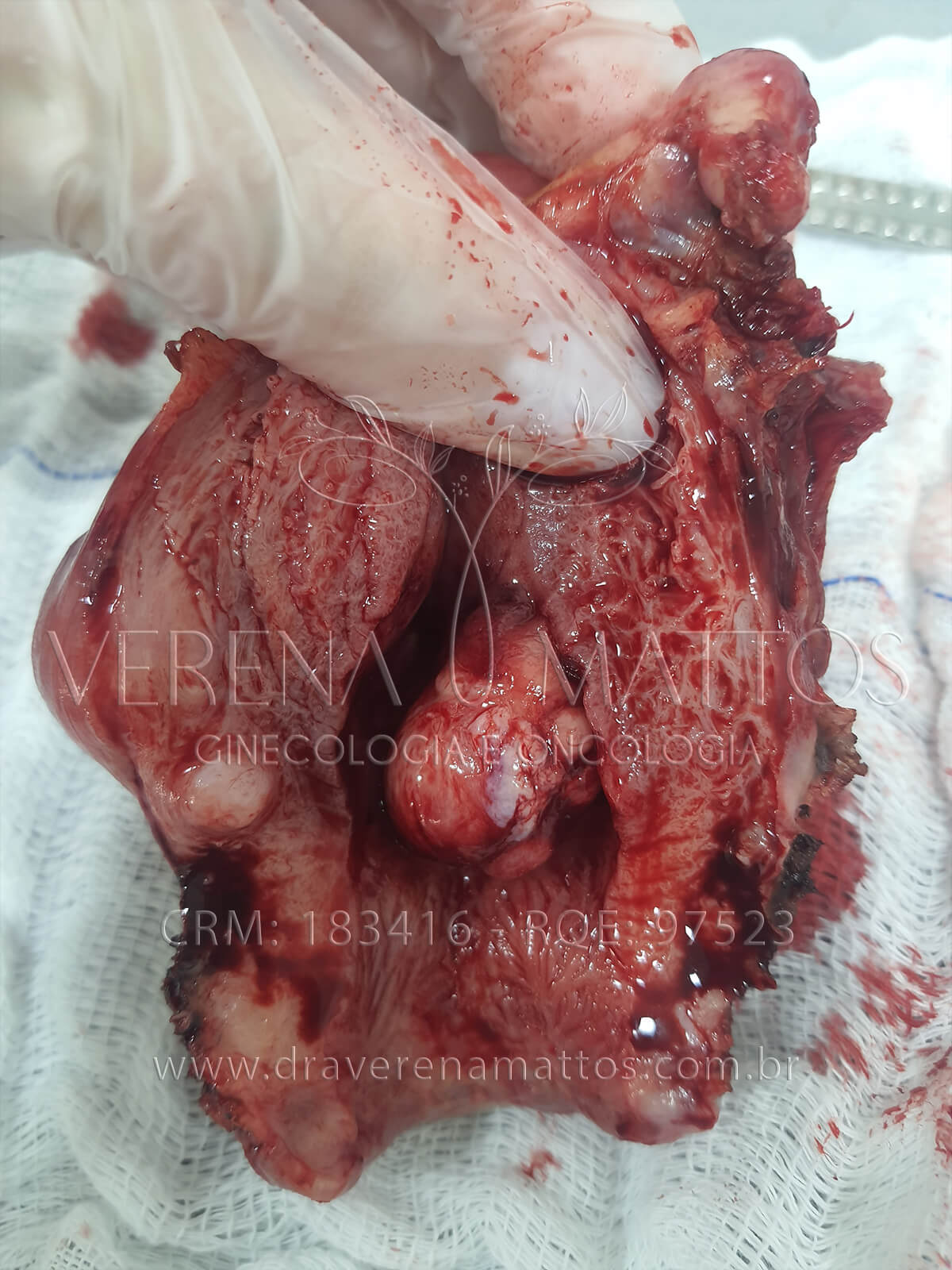 Foto de Útero com Mioma Submucoso