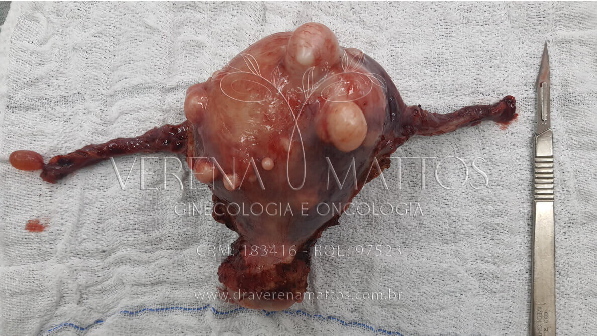 Foto de Útero com Miomas